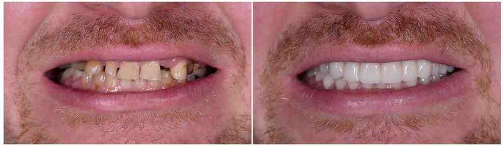 How long will dental implants last?