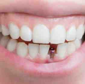 How long will implants hurt?