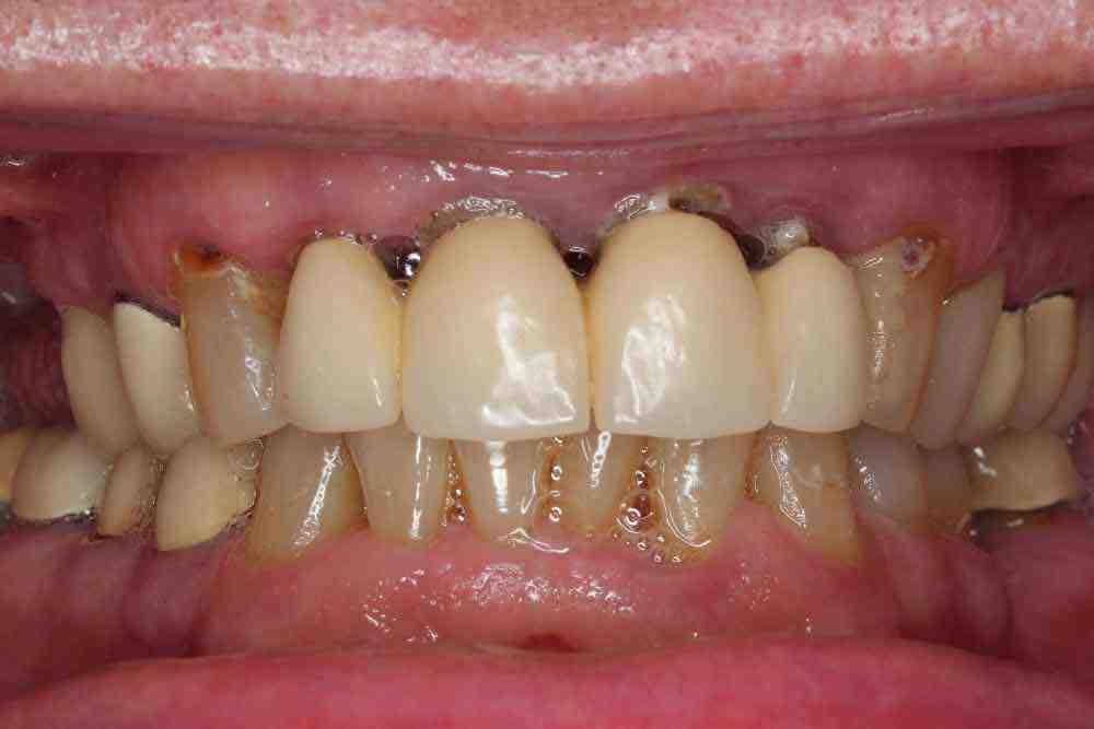 How long will teeth implants last?