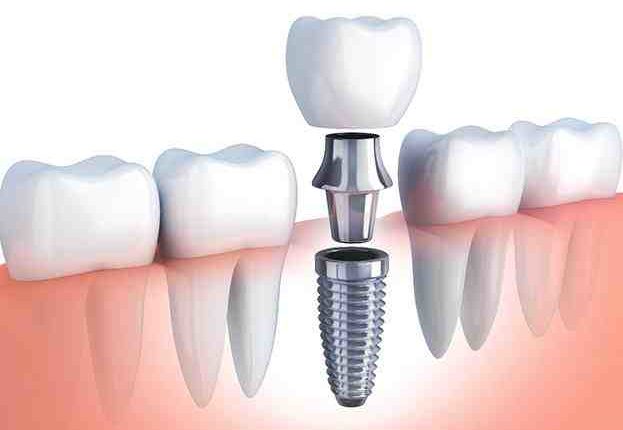 How many days swallow after bone graft for dental implant