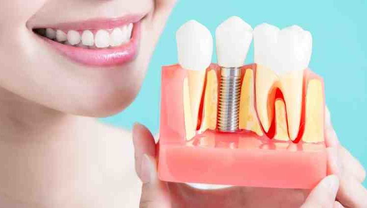 How many dental implants can be done at one time