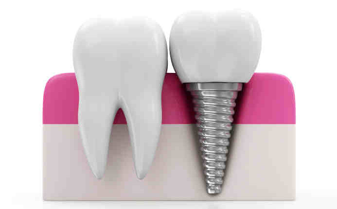 How many dental implants were placed in 2015