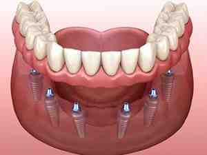 How many hours a day should I wear my temporary dentures?