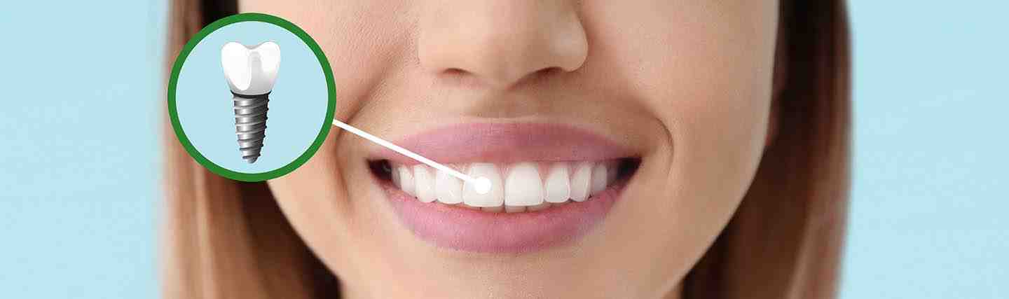How many implants are needed for a full mouth?
