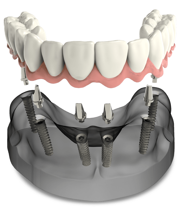 How many implants are needed for a partial denture?