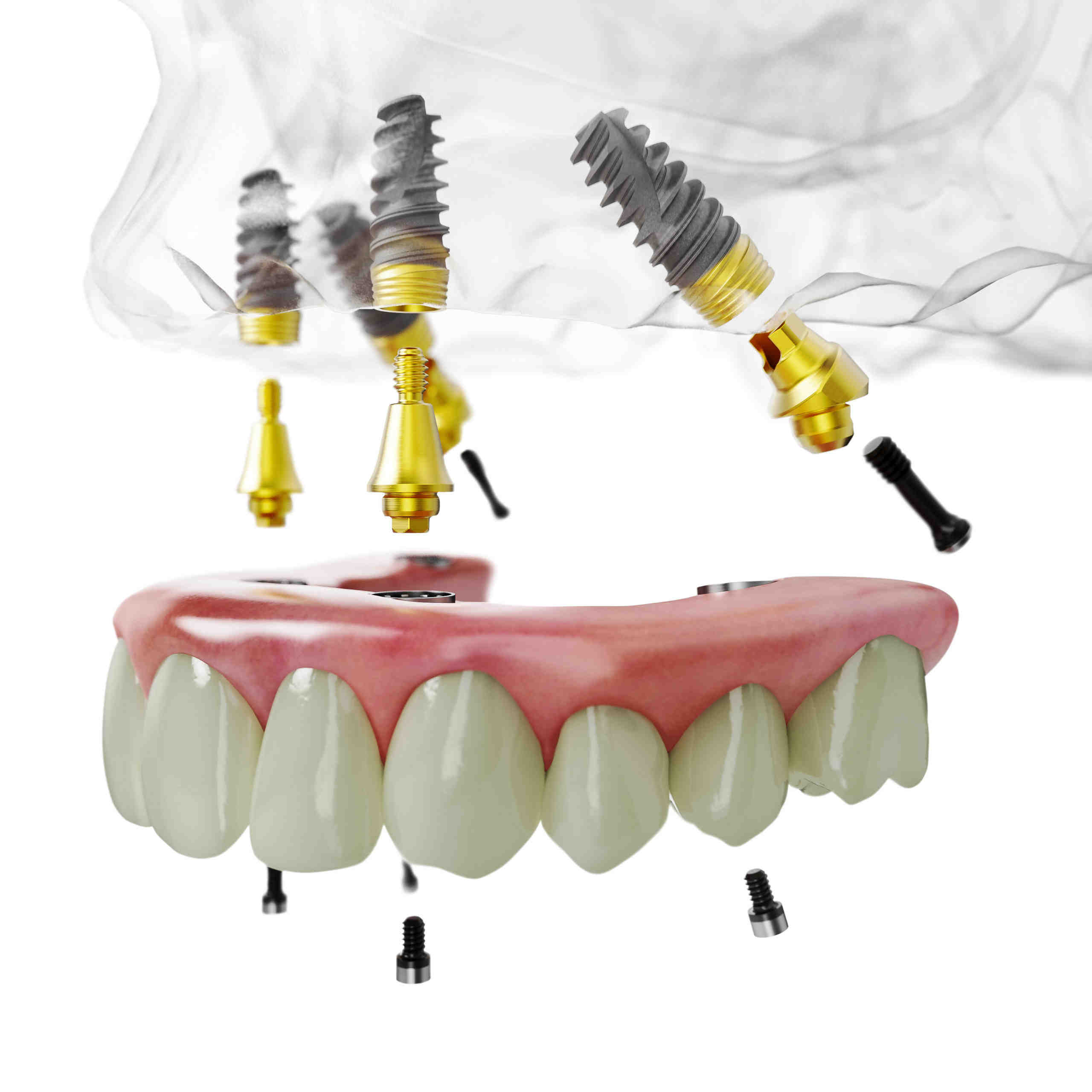 How many implants are needed for a top denture?