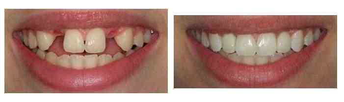 How many implants are needed for full set of teeth?