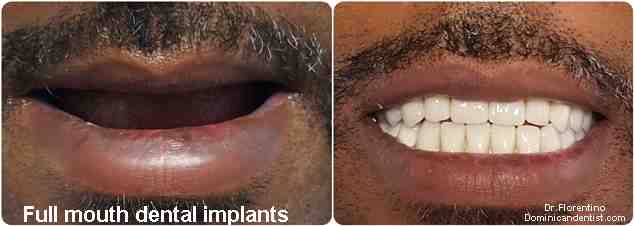 How many implants do I need for a full arch?