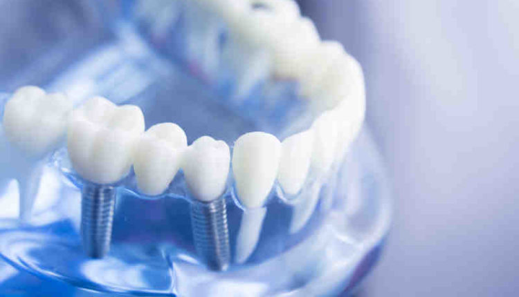 How many space need for one dental implant