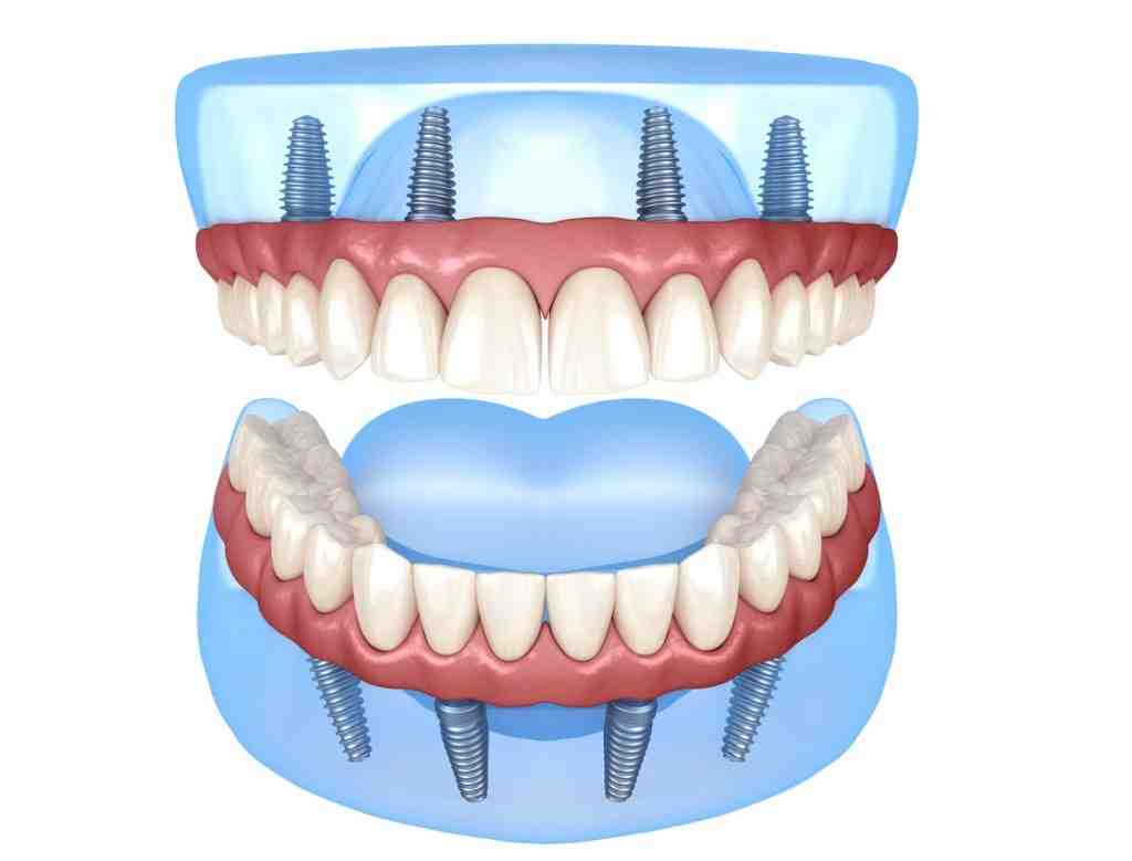 How many teeth are in All-on-4?