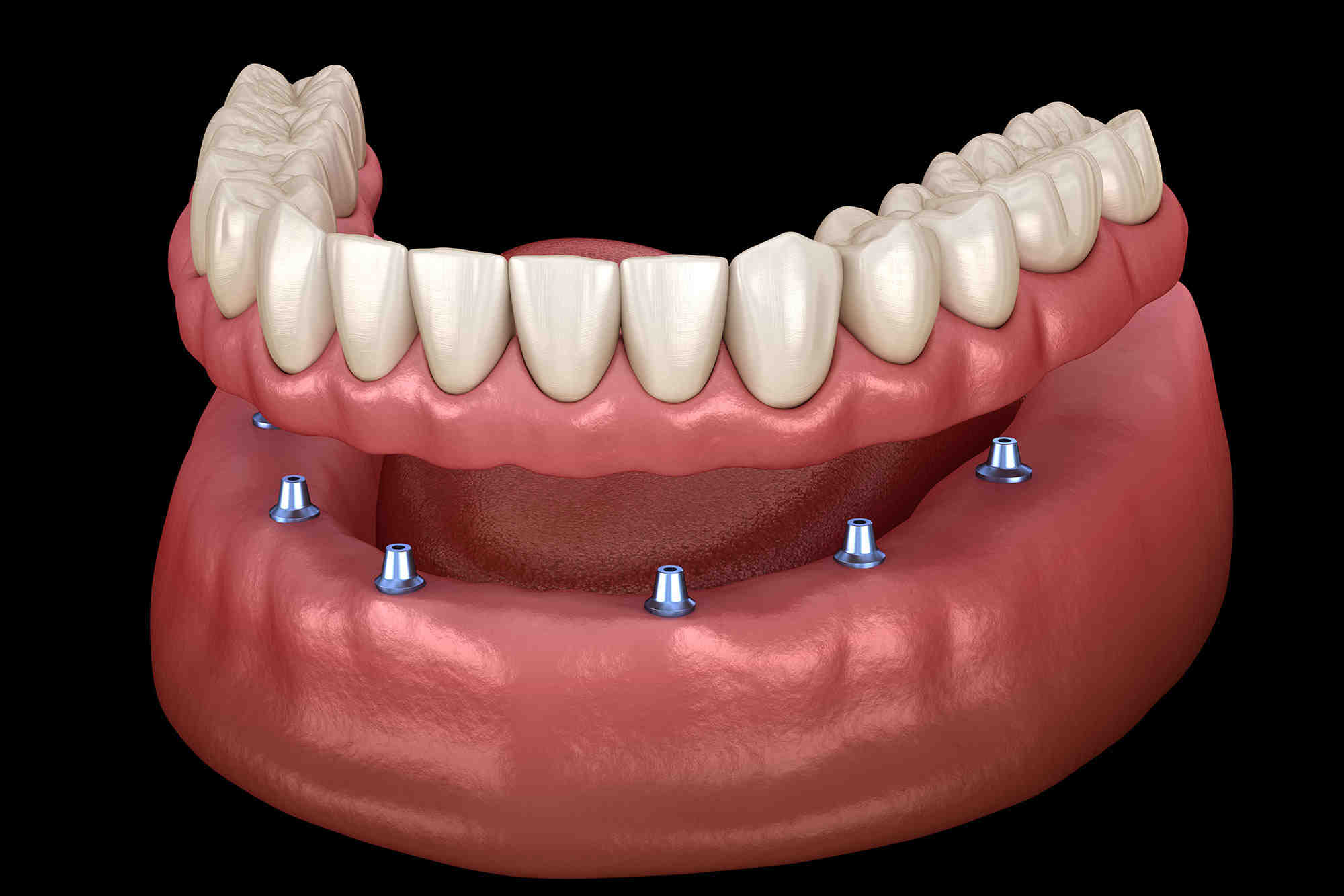 How many teeth are on All-on-4?