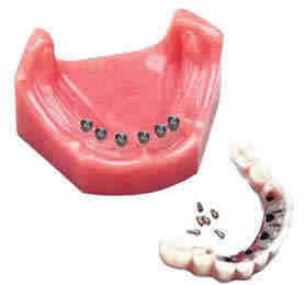 How many teeth can you get on one implant?