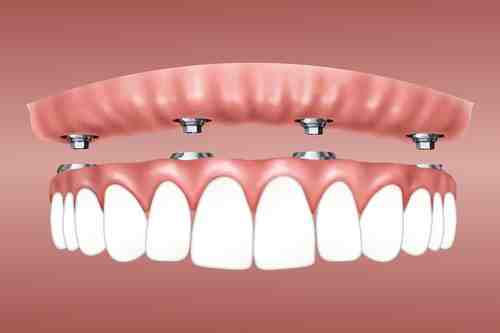 How many teeth can you put on one dental implant?