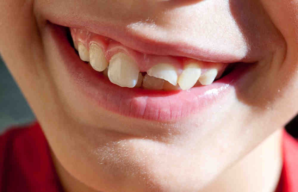 How many types of false teeth are there?