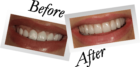 How many veneers are in a full set?