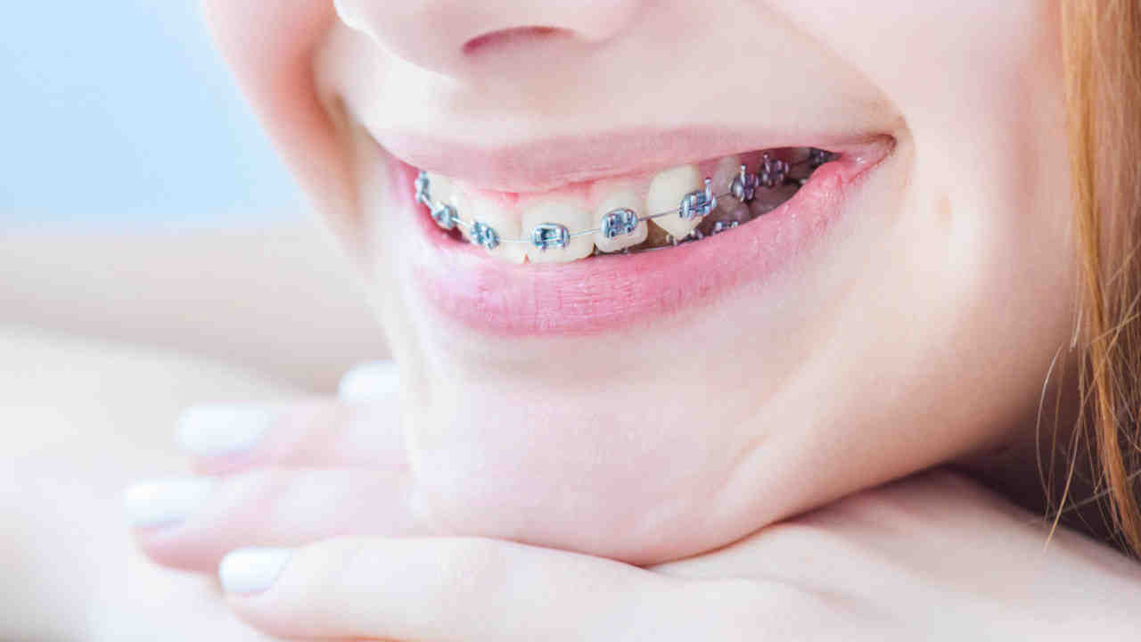How many visits before you get braces?