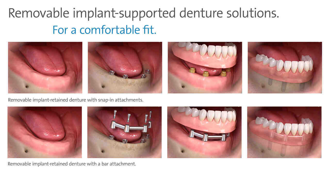 How many years do dental implants last?