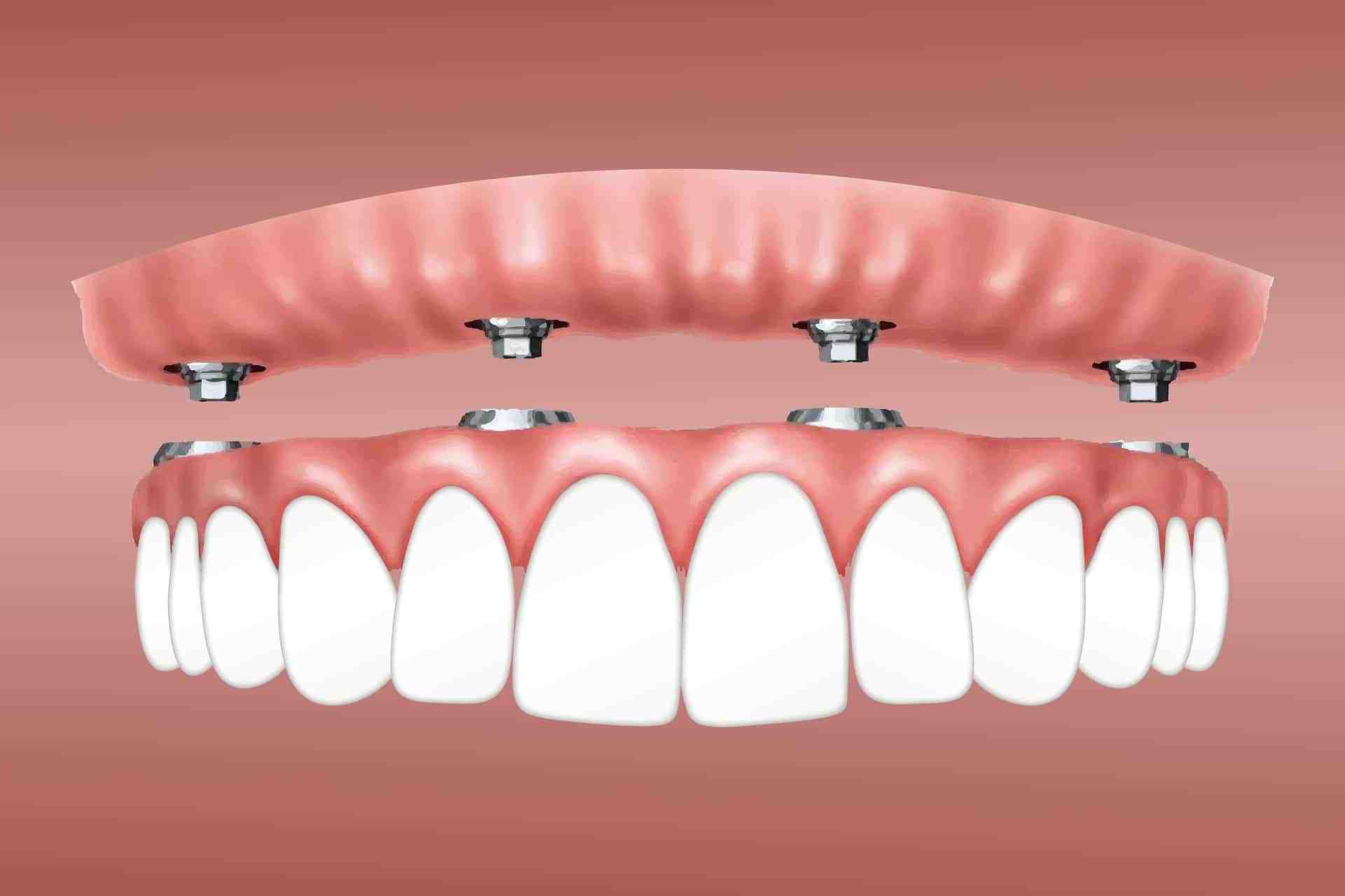 How many years do dental implants last?