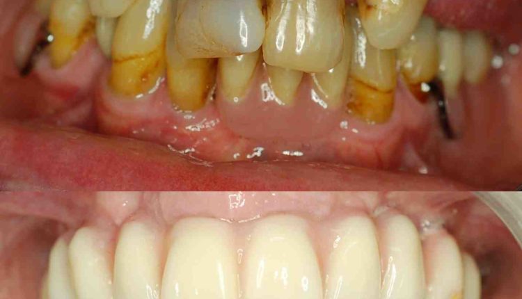 How mich is a complete full dental implants