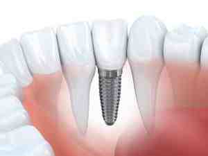 How much are all on 4 dental implants in Mexico?