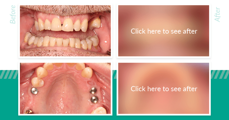 How much are dental implants for top and bottom?
