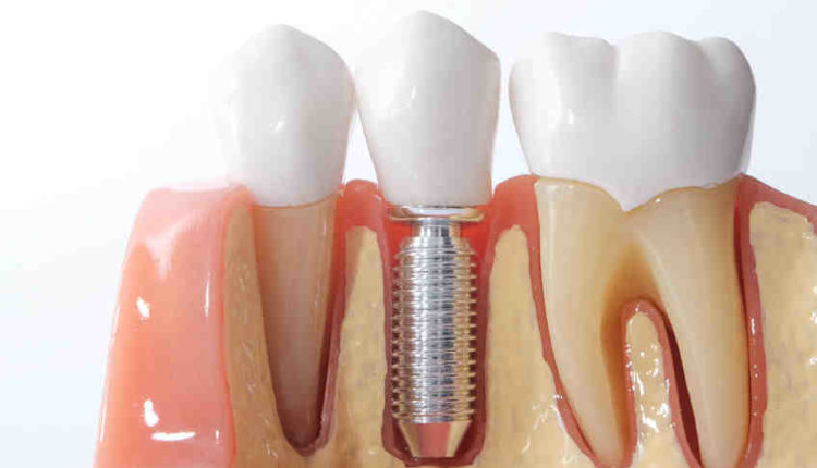 How much are dental implants in ct