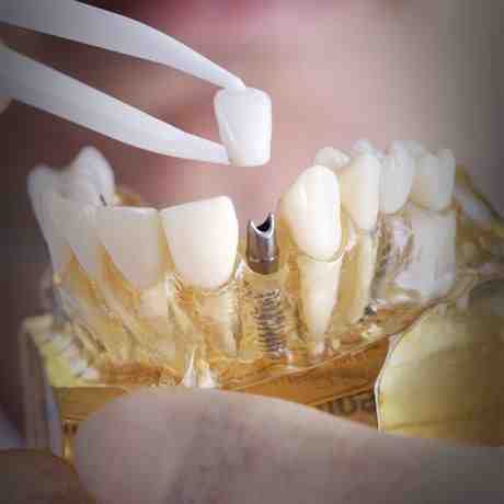 How much are tooth crowns worth?