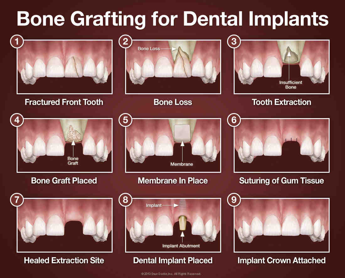 How much are tooth implants in Ontario?