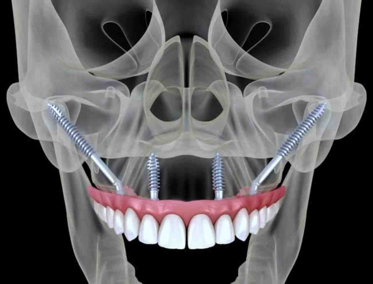 How much bone is needed for a dental implant?
