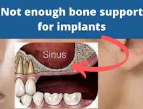 How much bone is needed for a dental implant?