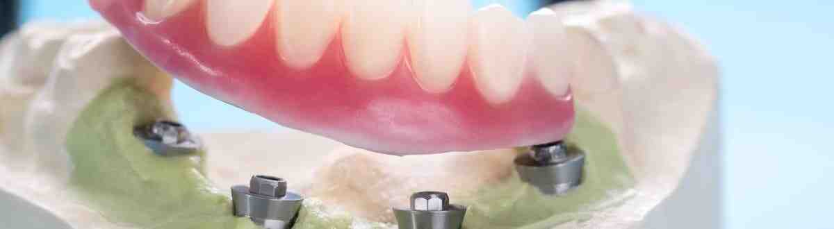 How much bone is required for a simple implant placement?
