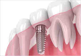 How much do braces cost?