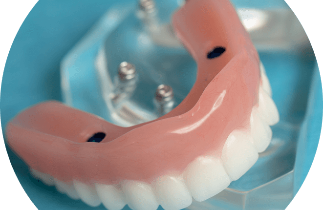 How much do dental implants cost in houston tx