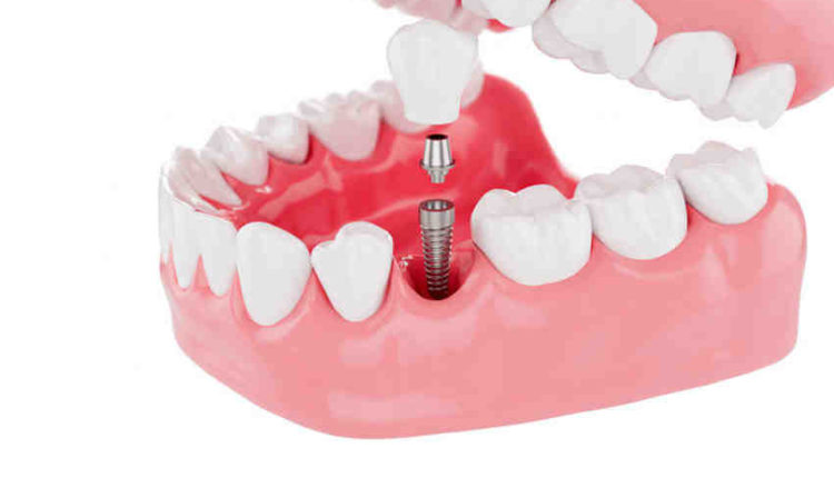 How much do dental implants cost in new york