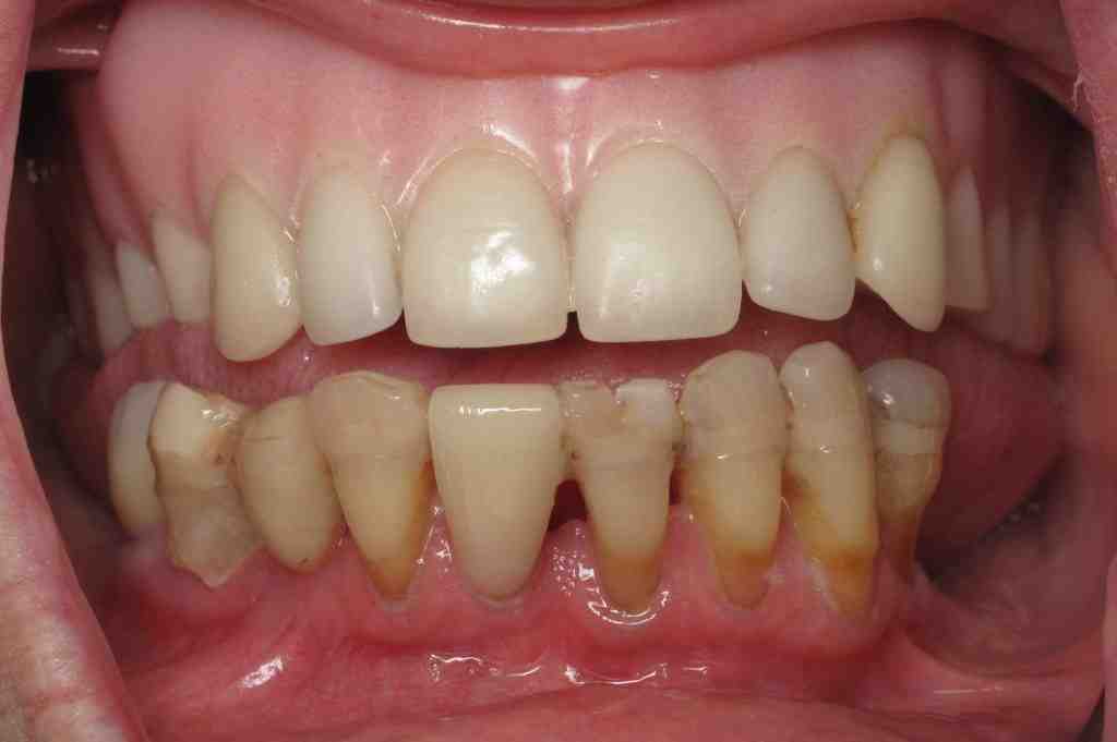 How much do dental implants cost near Fort Worth TX?