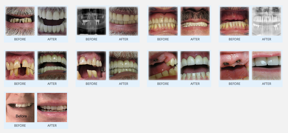 How much do full mouth dental implants cost in Florida?