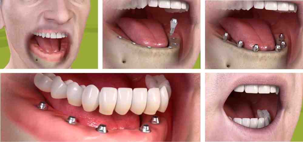 How much do full top teeth implants cost?