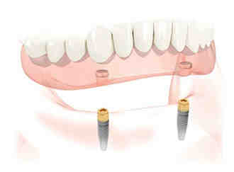 How much do implants cost?