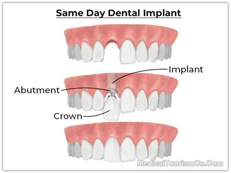 How much do most dental implants cost?