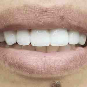 How much do top and bottom implants cost?