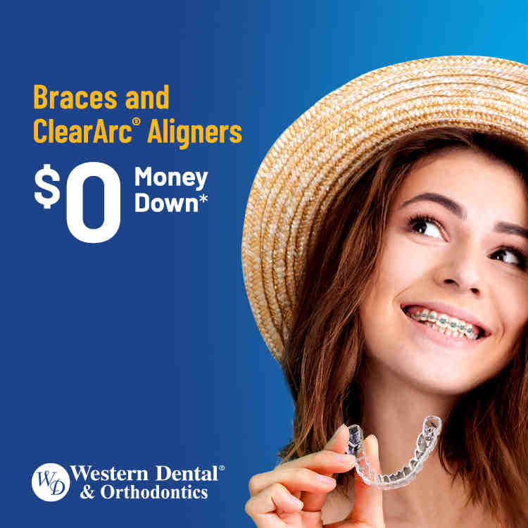 How much do veneers cost?