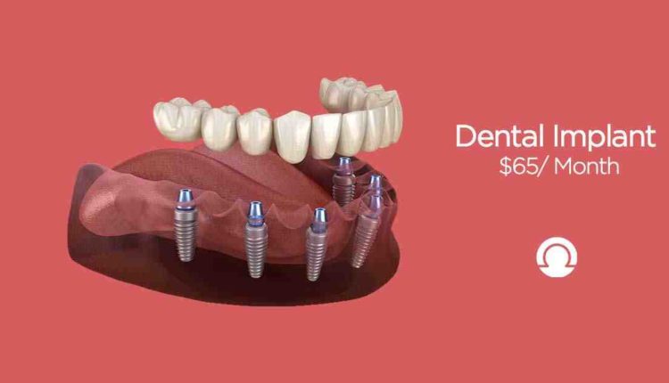 How much does a dental implant cost nj