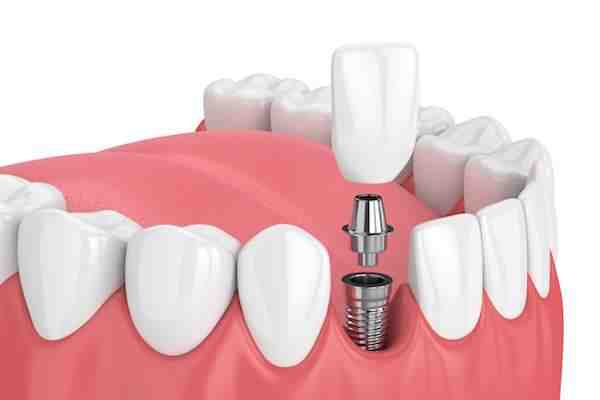 How much does a full set of teeth implants cost?