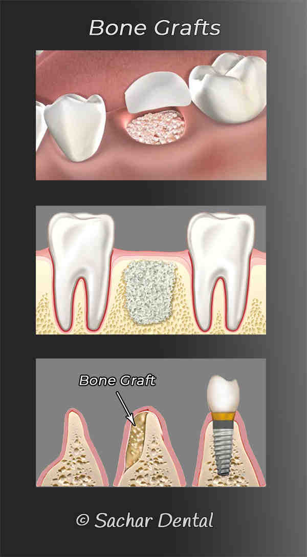 How Much Does A Full Set Of Teeth Implants Cost In Mexico