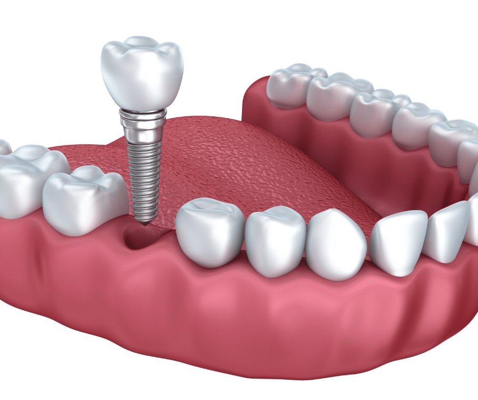 How much does a full set of teeth implants cost?