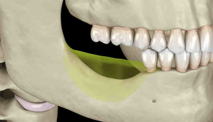 How much does it cost for bone grafting for dental implants