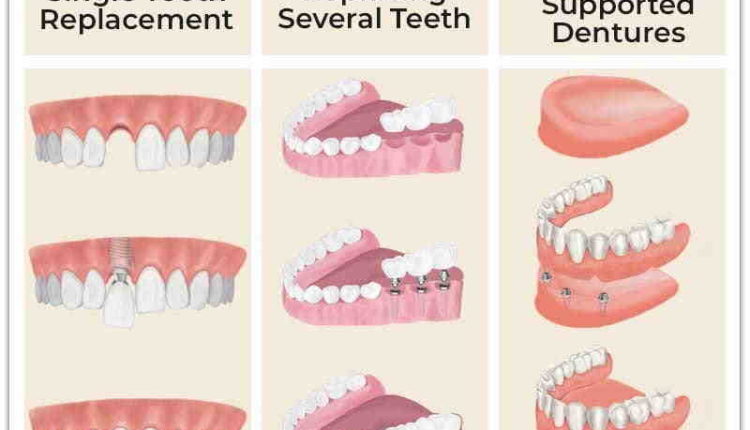 How much does it cost to get full mouth dental implants