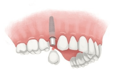 How much does it cost to have a tooth added to a partial denture?