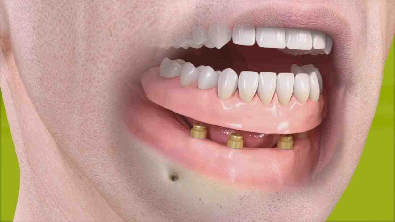 How much does it cost to have implants put in your mouth?