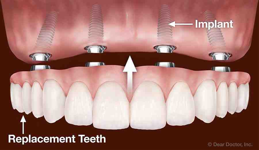 How much does it cost to replace a full set of teeth?